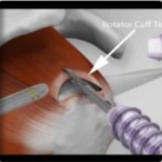 ARTHROSCOPIC ROTATOR CUFF REPAIR